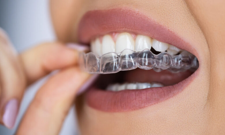 Best Teeth Aligners UK